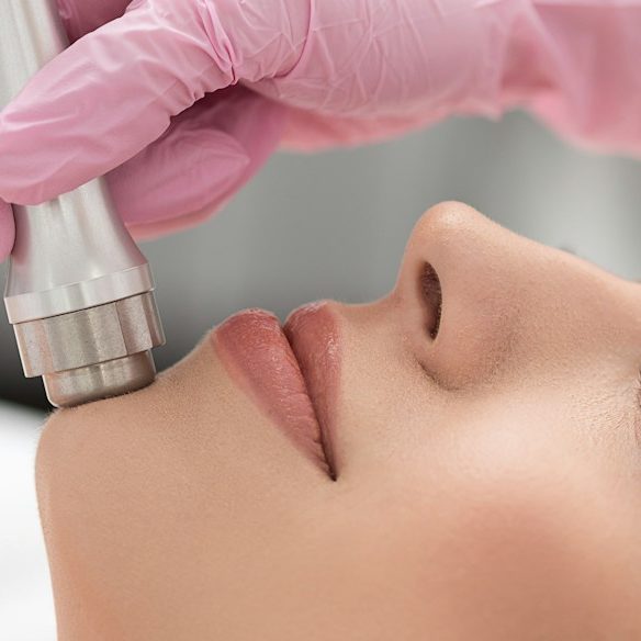 Microdermabrasion Behandlung von Hautproblemen